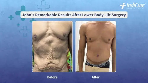 Before and after photos of John's abdomen showing the remarkable results of his lower body lift (skin removal surgery), completing his weight loss transformation with a contoured torso.